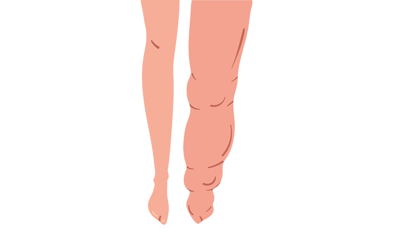 Legs with severe swelling, pronounced skin folds, and deformity. Legs with severe swelling, pronounced skin folds, and deformity.